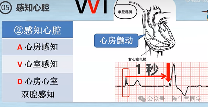 心电图器怎么用起搏器入门，简单易懂！_https://www.jmylbn.com_新闻资讯_第32张