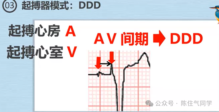 心电图器怎么用起搏器入门，简单易懂！_https://www.jmylbn.com_新闻资讯_第19张