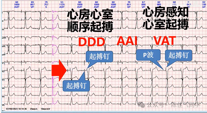 心电图器怎么用起搏器入门，简单易懂！_https://www.jmylbn.com_新闻资讯_第26张