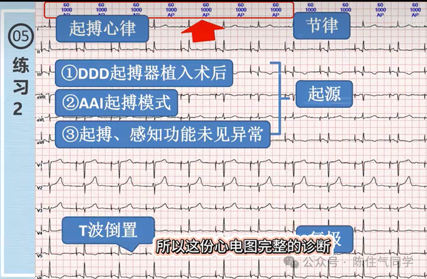 心电图器怎么用起搏器入门，简单易懂！_https://www.jmylbn.com_新闻资讯_第56张