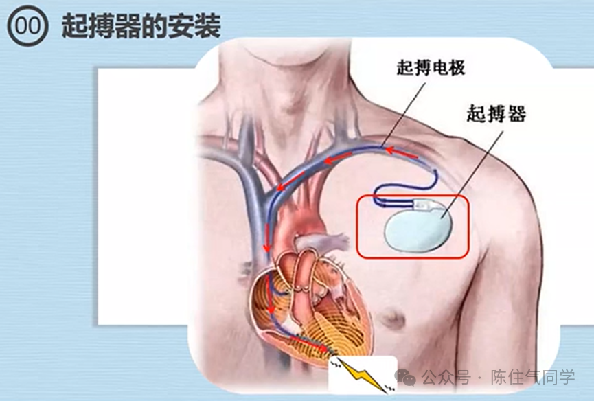 心电图器怎么用起搏器入门，简单易懂！_https://www.jmylbn.com_新闻资讯_第4张
