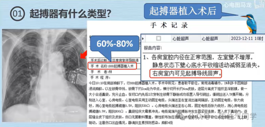 心电图器怎么用起搏器入门，简单易懂！_https://www.jmylbn.com_新闻资讯_第43张