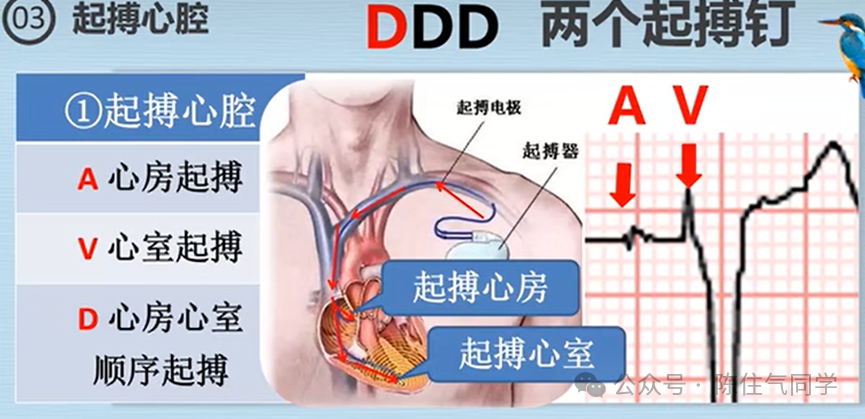 心电图器怎么用起搏器入门，简单易懂！_https://www.jmylbn.com_新闻资讯_第30张