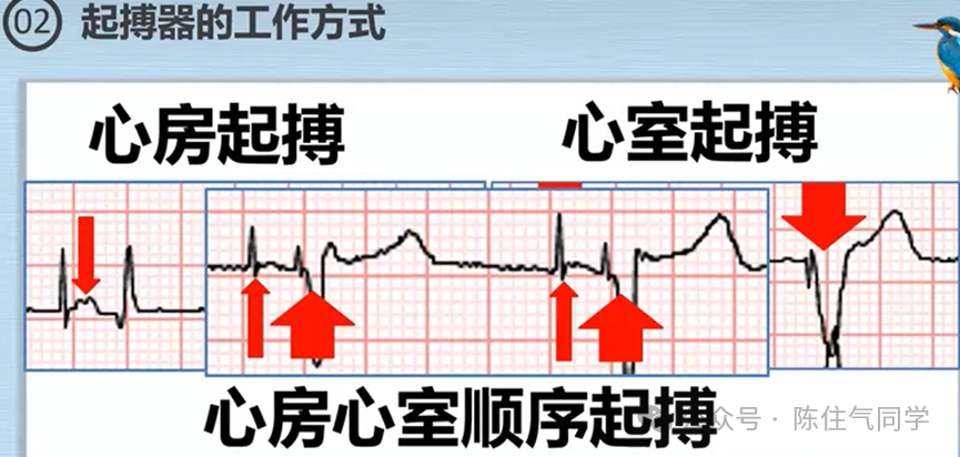 心电图器怎么用起搏器入门，简单易懂！_https://www.jmylbn.com_新闻资讯_第44张
