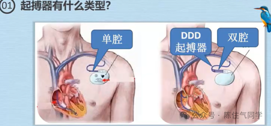 心电图器怎么用起搏器入门，简单易懂！_https://www.jmylbn.com_新闻资讯_第42张