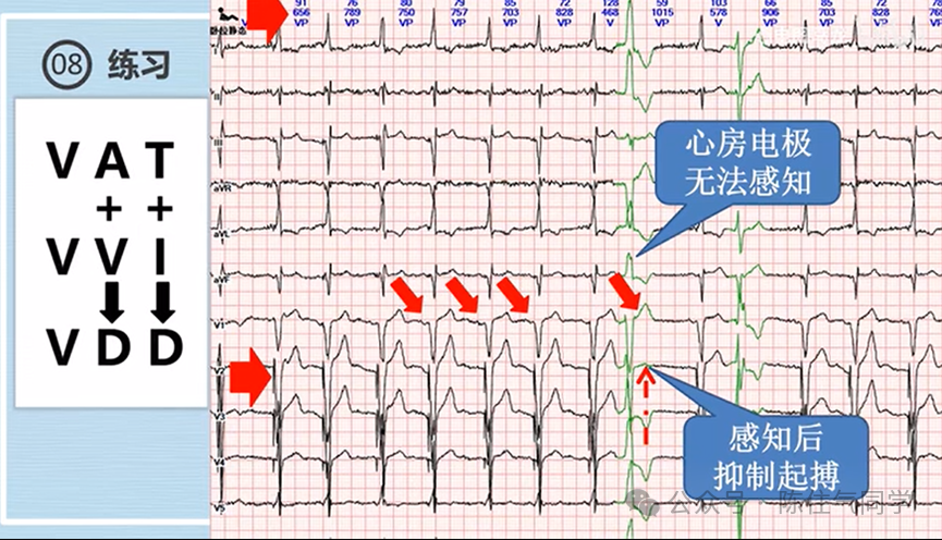 心电图器怎么用起搏器入门，简单易懂！_https://www.jmylbn.com_新闻资讯_第36张
