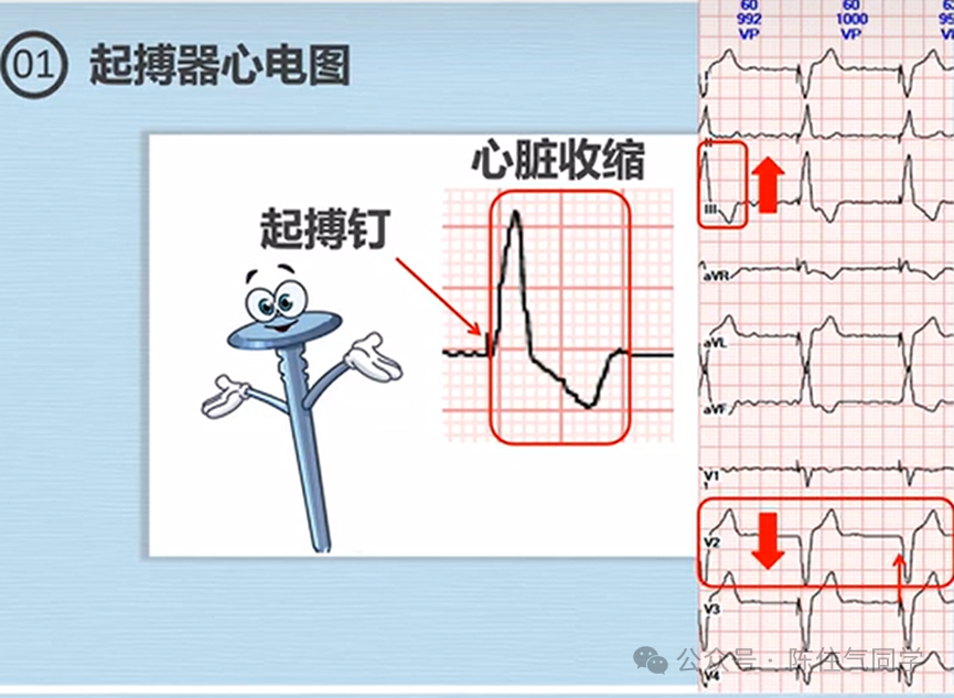 心电图器怎么用起搏器入门，简单易懂！_https://www.jmylbn.com_新闻资讯_第5张