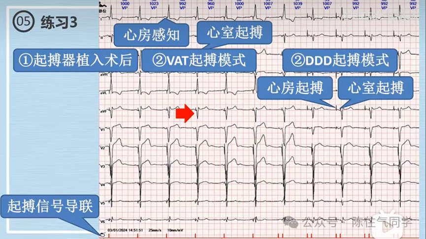 心电图器怎么用起搏器入门，简单易懂！_https://www.jmylbn.com_新闻资讯_第57张