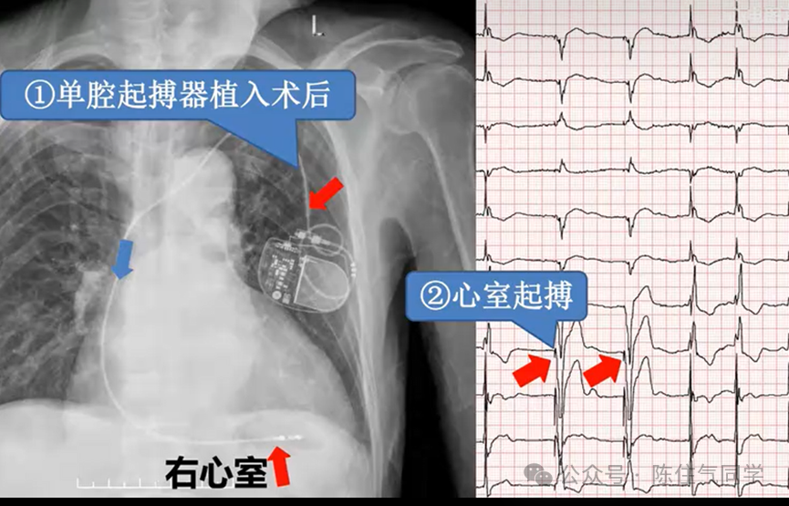 心电图器怎么用起搏器入门，简单易懂！_https://www.jmylbn.com_新闻资讯_第52张