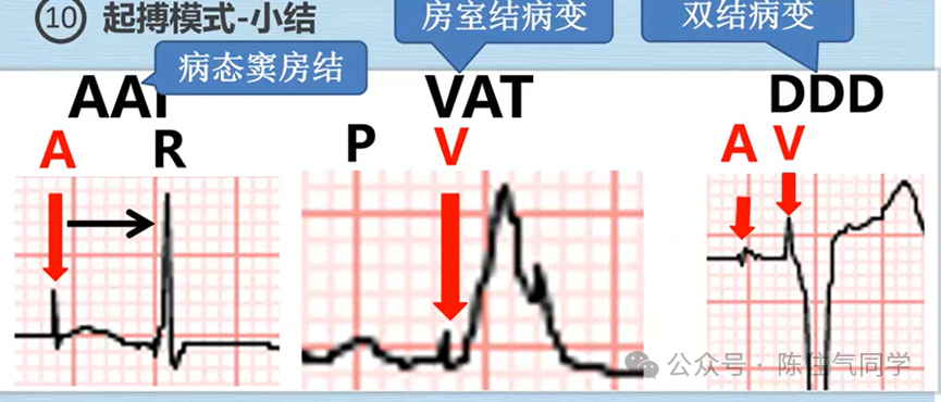 心电图器怎么用起搏器入门，简单易懂！_https://www.jmylbn.com_新闻资讯_第24张