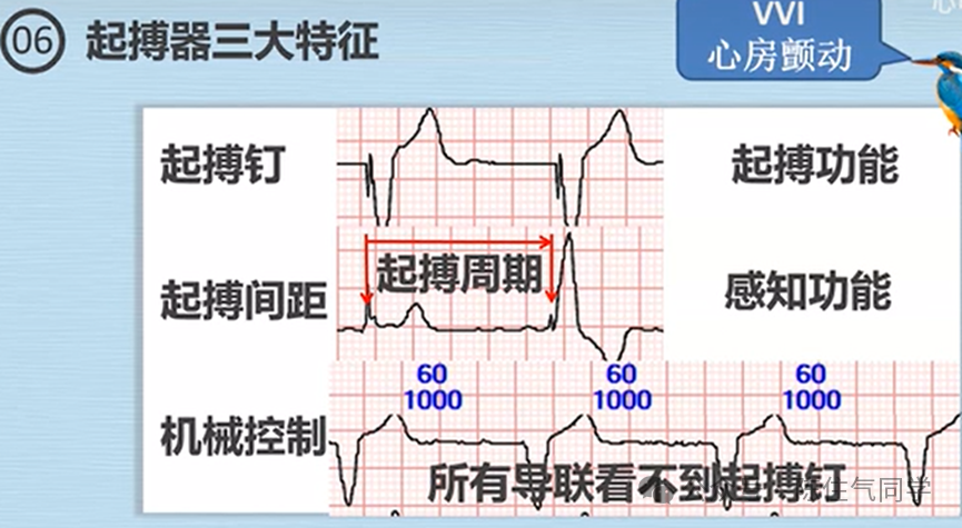 心电图器怎么用起搏器入门，简单易懂！_https://www.jmylbn.com_新闻资讯_第13张