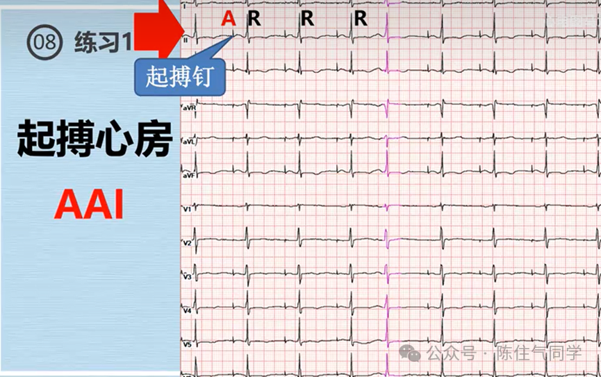 心电图器怎么用起搏器入门，简单易懂！_https://www.jmylbn.com_新闻资讯_第25张