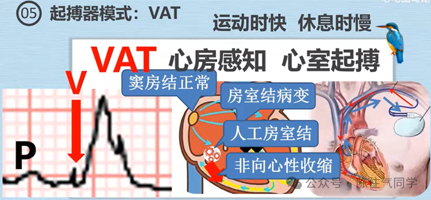 心电图器怎么用起搏器入门，简单易懂！_https://www.jmylbn.com_新闻资讯_第21张