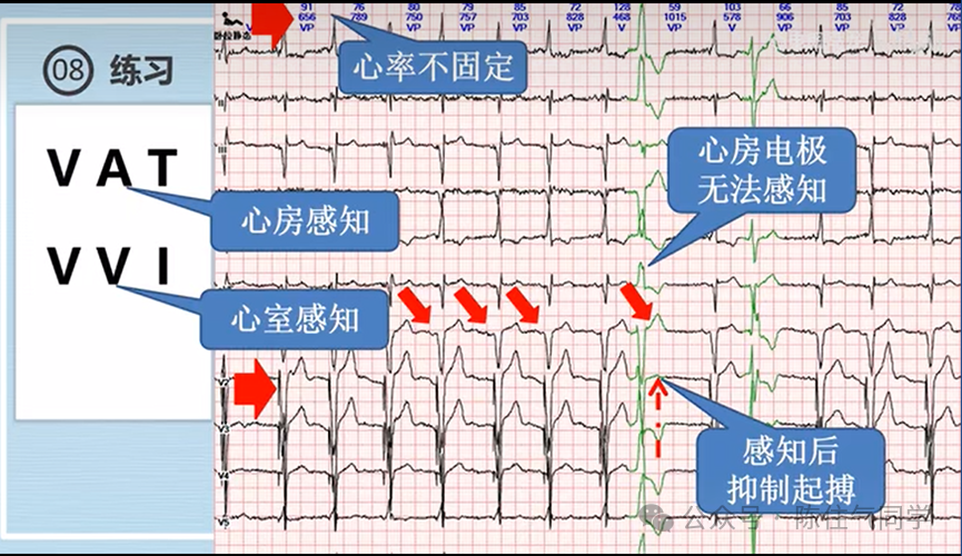心电图器怎么用起搏器入门，简单易懂！_https://www.jmylbn.com_新闻资讯_第35张