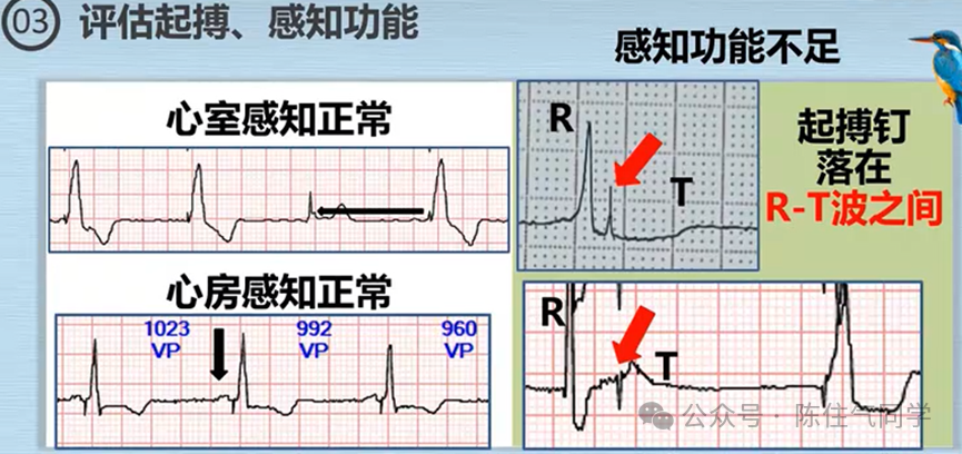 心电图器怎么用起搏器入门，简单易懂！_https://www.jmylbn.com_新闻资讯_第50张
