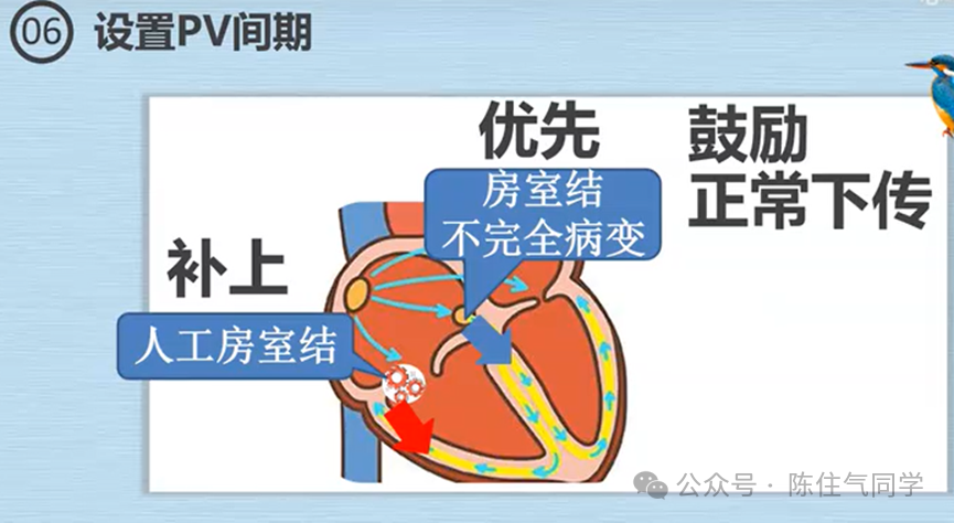 心电图器怎么用起搏器入门，简单易懂！_https://www.jmylbn.com_新闻资讯_第22张