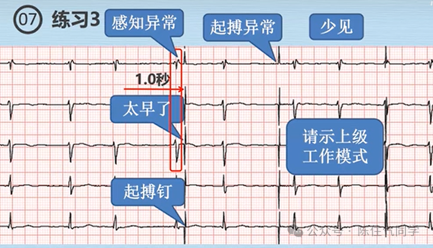 心电图器怎么用起搏器入门，简单易懂！_https://www.jmylbn.com_新闻资讯_第14张