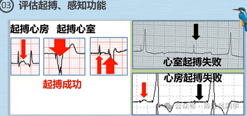 心电图器怎么用起搏器入门，简单易懂！_https://www.jmylbn.com_新闻资讯_第49张