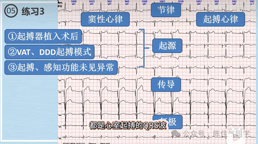 心电图器怎么用起搏器入门，简单易懂！_https://www.jmylbn.com_新闻资讯_第58张