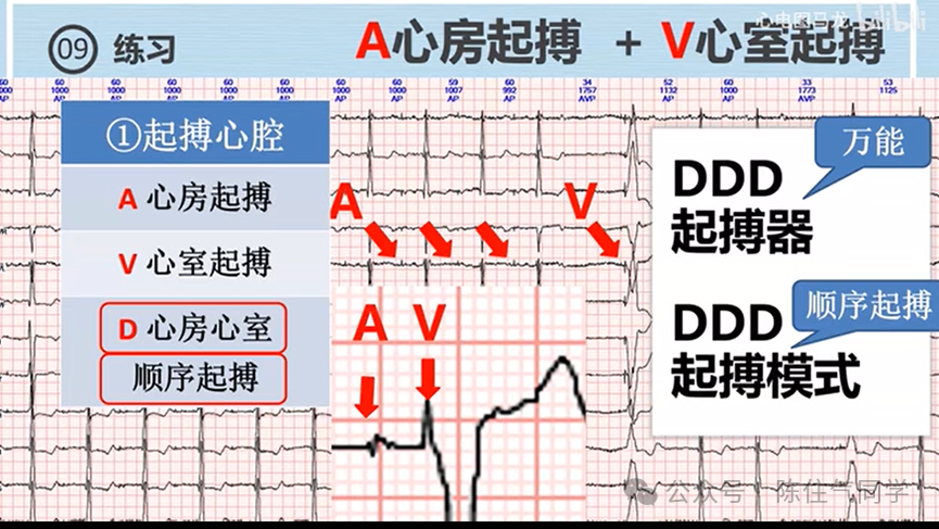 心电图器怎么用起搏器入门，简单易懂！_https://www.jmylbn.com_新闻资讯_第37张