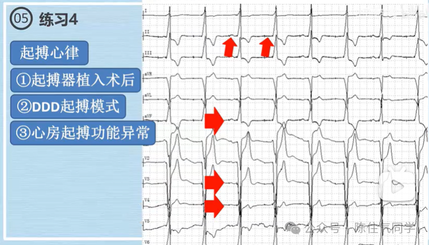 心电图器怎么用起搏器入门，简单易懂！_https://www.jmylbn.com_新闻资讯_第60张
