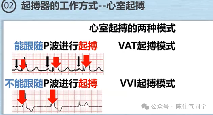 心电图器怎么用起搏器入门，简单易懂！_https://www.jmylbn.com_新闻资讯_第46张