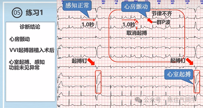 心电图器怎么用起搏器入门，简单易懂！_https://www.jmylbn.com_新闻资讯_第11张