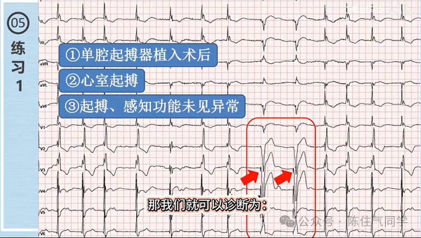 心电图器怎么用起搏器入门，简单易懂！_https://www.jmylbn.com_新闻资讯_第53张