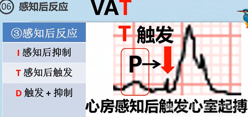 心电图器怎么用起搏器入门，简单易懂！_https://www.jmylbn.com_新闻资讯_第33张
