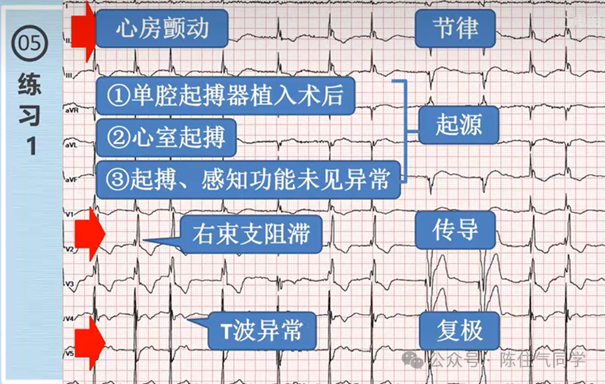 心电图器怎么用起搏器入门，简单易懂！_https://www.jmylbn.com_新闻资讯_第54张