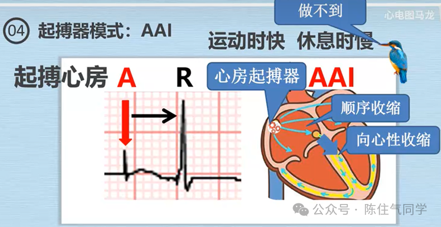 心电图器怎么用起搏器入门，简单易懂！_https://www.jmylbn.com_新闻资讯_第20张