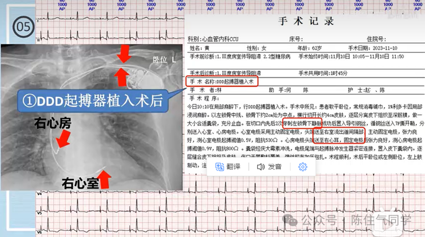 心电图器怎么用起搏器入门，简单易懂！_https://www.jmylbn.com_新闻资讯_第55张