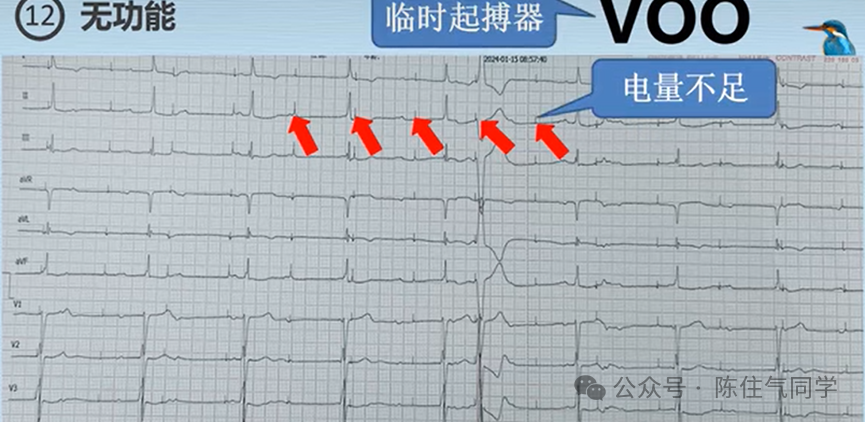 心电图器怎么用起搏器入门，简单易懂！_https://www.jmylbn.com_新闻资讯_第39张