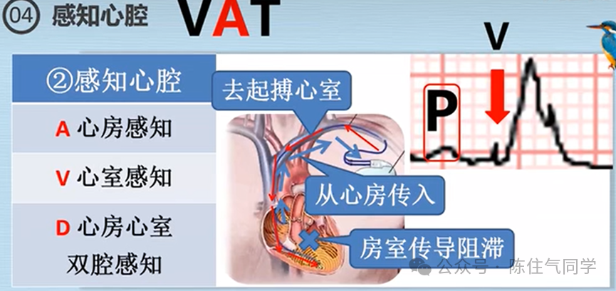 心电图器怎么用起搏器入门，简单易懂！_https://www.jmylbn.com_新闻资讯_第31张