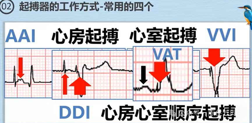 心电图器怎么用起搏器入门，简单易懂！_https://www.jmylbn.com_新闻资讯_第48张