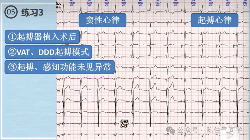 心电图器怎么用起搏器入门，简单易懂！_https://www.jmylbn.com_新闻资讯_第59张