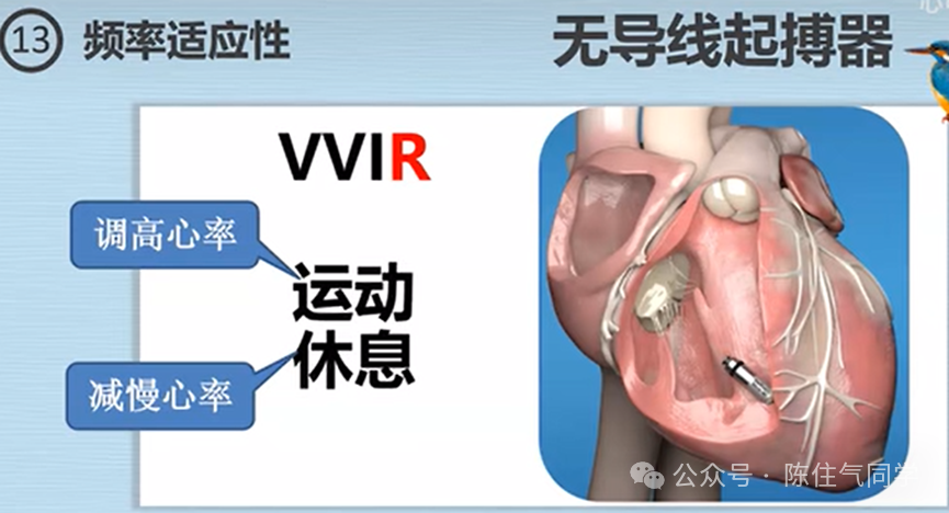心电图器怎么用起搏器入门，简单易懂！_https://www.jmylbn.com_新闻资讯_第40张