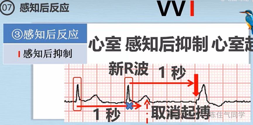 心电图器怎么用起搏器入门，简单易懂！_https://www.jmylbn.com_新闻资讯_第34张