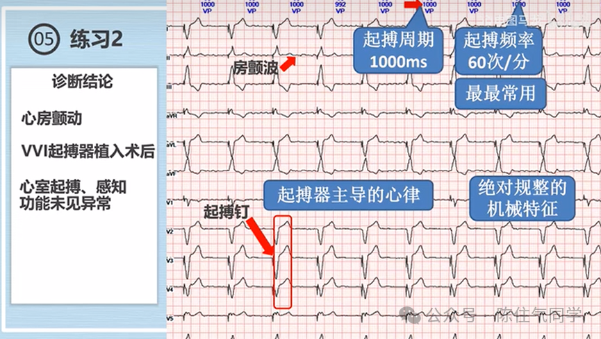 心电图器怎么用起搏器入门，简单易懂！_https://www.jmylbn.com_新闻资讯_第12张