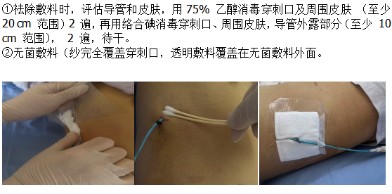 引流管怎么标识临医科普 ｜ 经皮肝穿刺胆道引流管的居家护理——带你了解PTCD_https://www.jmylbn.com_新闻资讯_第11张