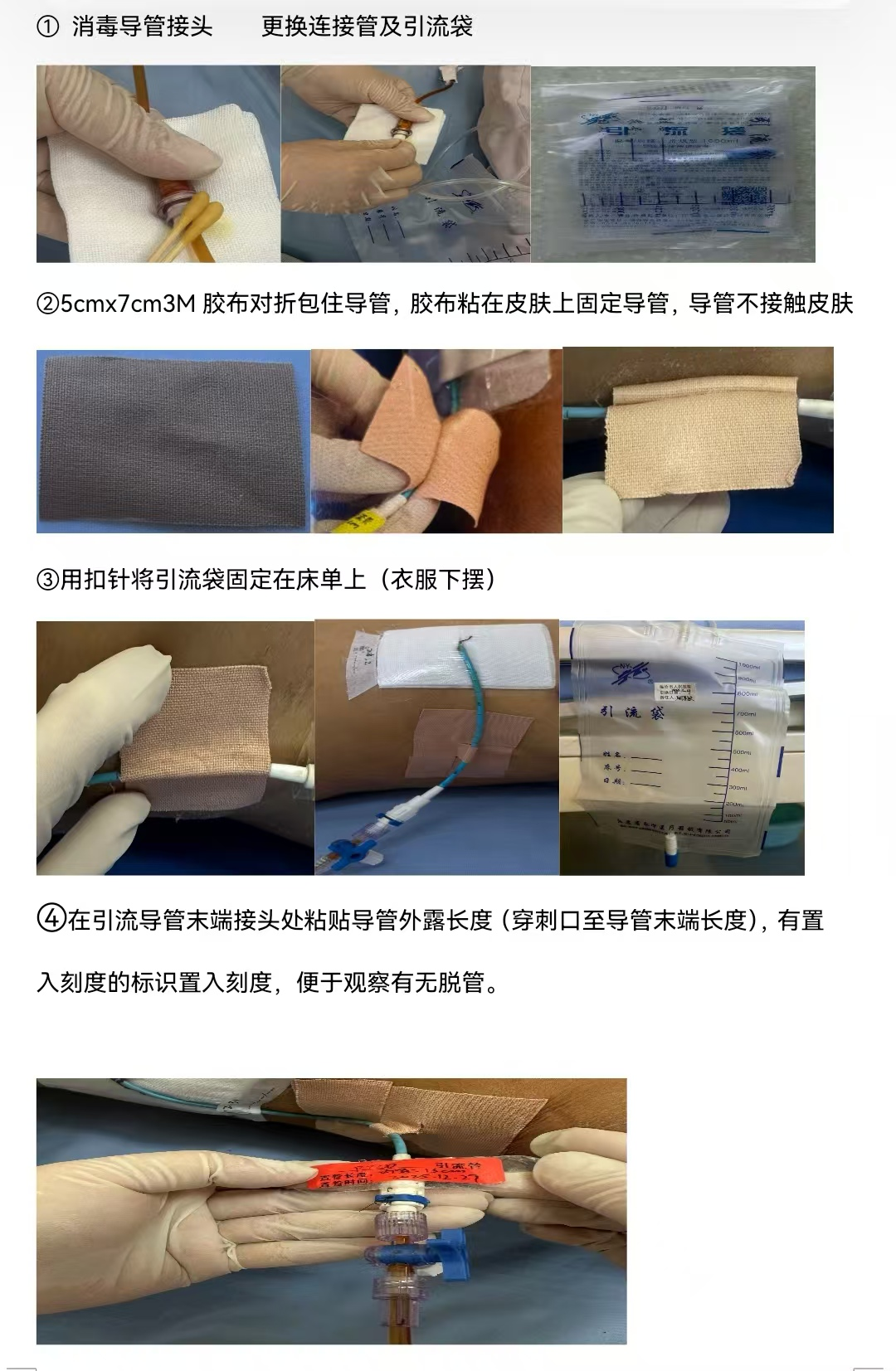 引流管怎么标识临医科普 ｜ 经皮肝穿刺胆道引流管的居家护理——带你了解PTCD_https://www.jmylbn.com_新闻资讯_第10张