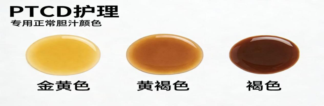 引流管怎么标识临医科普 ｜ 经皮肝穿刺胆道引流管的居家护理——带你了解PTCD_https://www.jmylbn.com_新闻资讯_第7张