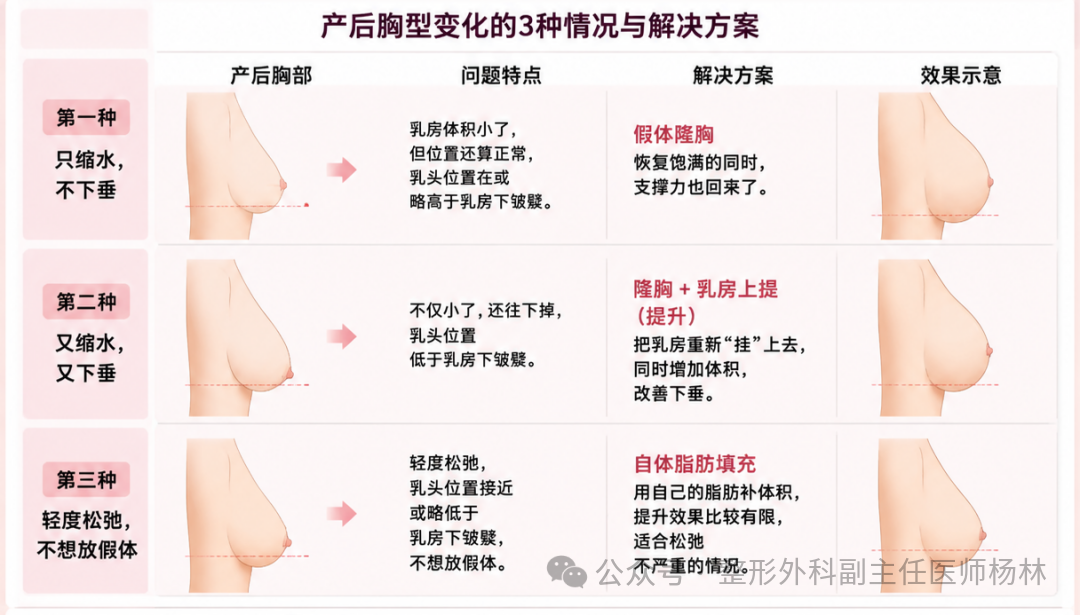 产后胸型变化的3种情况与解决方案