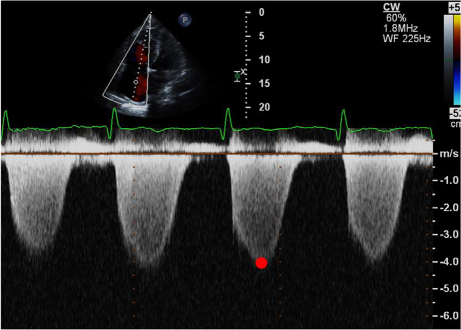 肺动脉高压超声评估简易流程