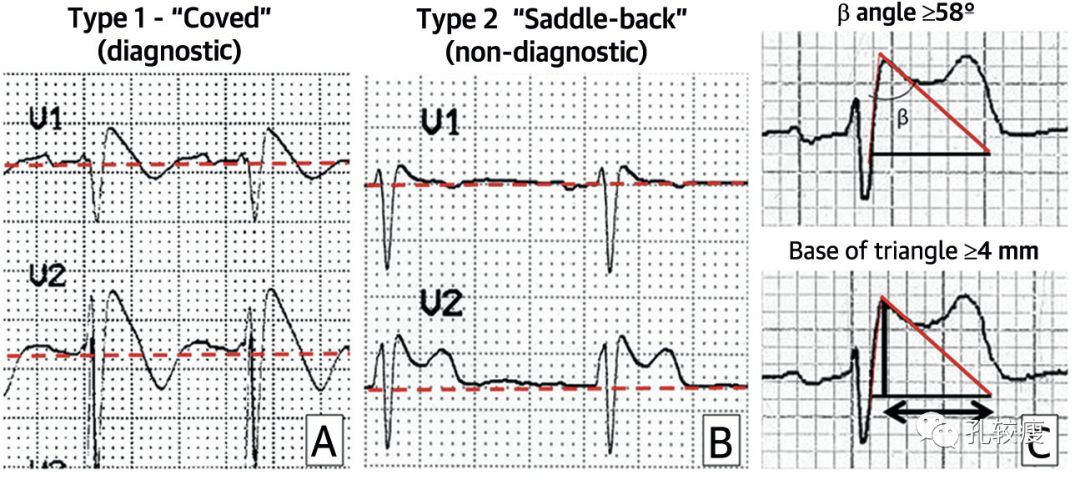10分钟掌握Brugada综合征