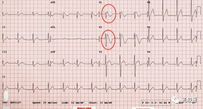 10分钟掌握Brugada综合征