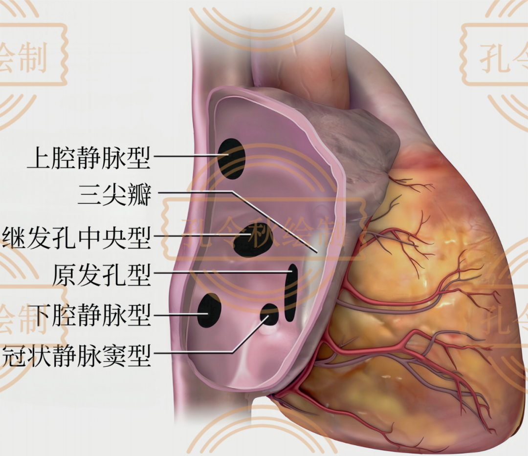 房间隔缺损大小，到底如何测量？