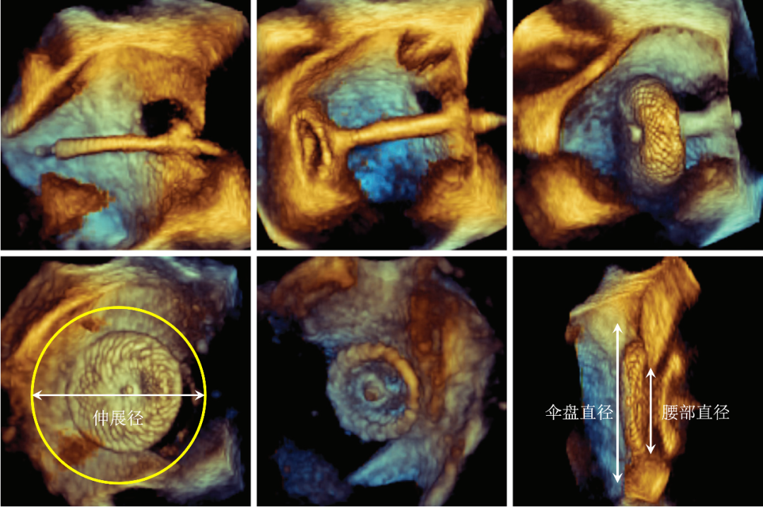 房间隔缺损大小，到底如何测量？