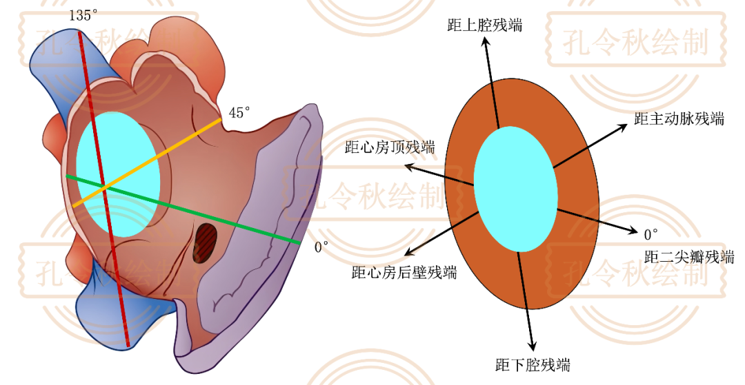 房间隔缺损大小，到底如何测量？