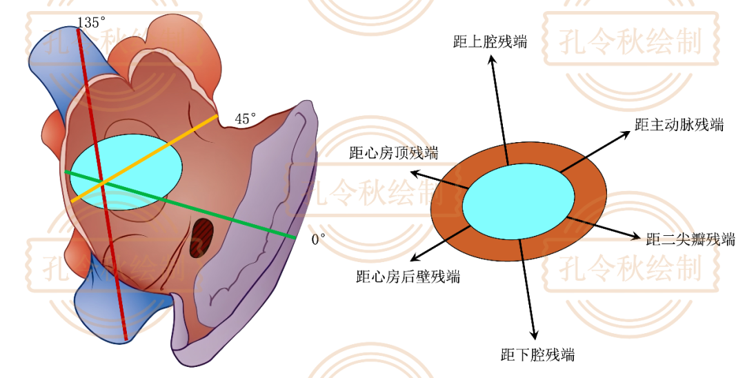 房间隔缺损大小，到底如何测量？